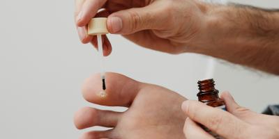 Warzen: In bestimmten Fällen helfen auch rezeptfreie Mittel aus der Apotheke