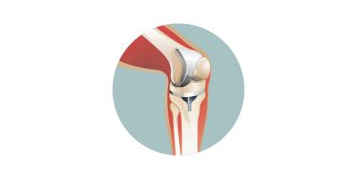 Illustration Kniegelenk Chirurgie Operation