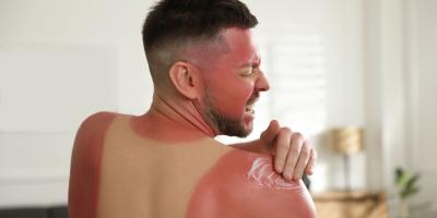 Hausmittel: Was hilft bei Sonnenbrand?
