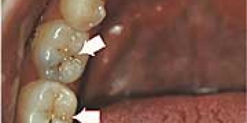 Karies in Fissur Karies in Fissur