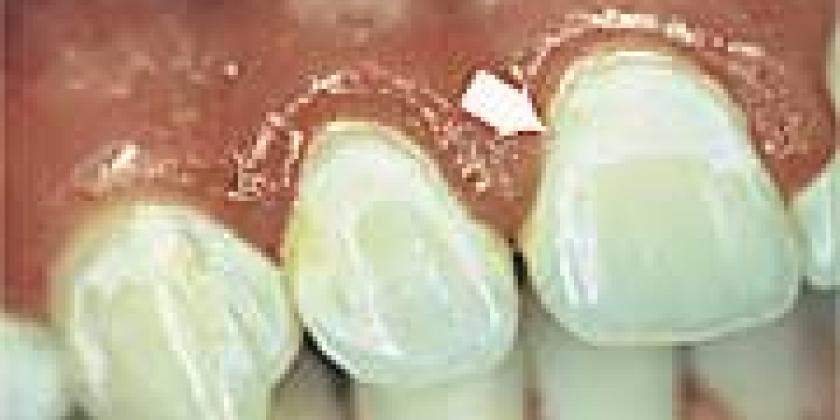 Kreidige Fläche am Zahn Kreidige Fläche am Zahn